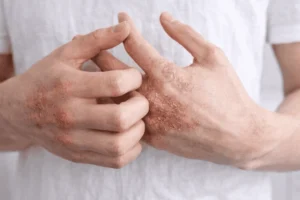 Veltrona blog post about the Psoriasis vs Eczema.