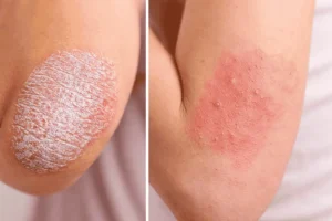 Veltrona blog post about the Psoriasis vs Eczema.